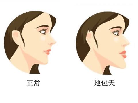什么是地包天？地包天長什么樣子？地包天牙齒圖片