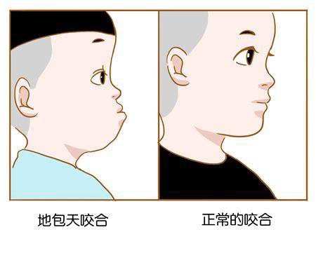什么是地包天？地包天長什么樣子？地包天牙齒圖片